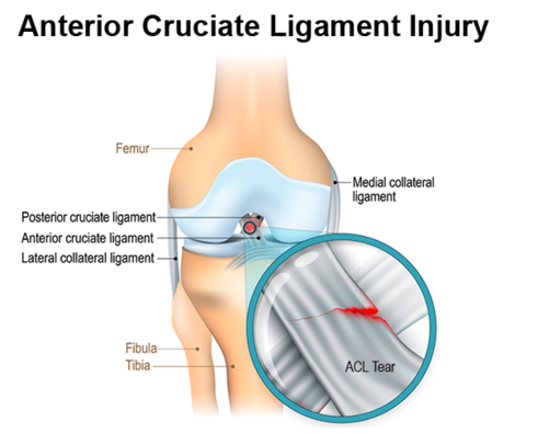 ACL Tear – Definition, Anatomy and Causes (Video) - Town Center