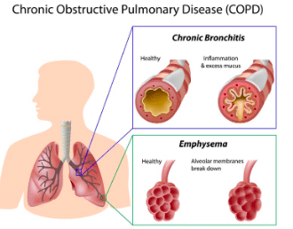 COPD