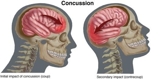 Concussion