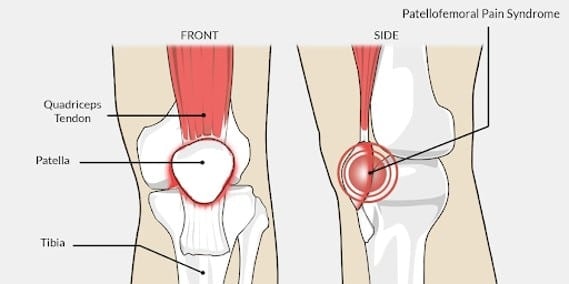 Knee Pain and Patellofemoral Pain Syndrome 