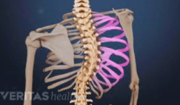 Scoliosis