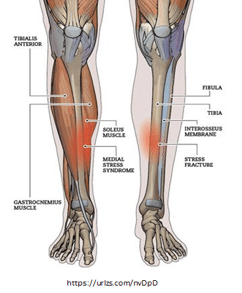 What to do when you get shin splints? - 3 Dimensional Physical Therapy