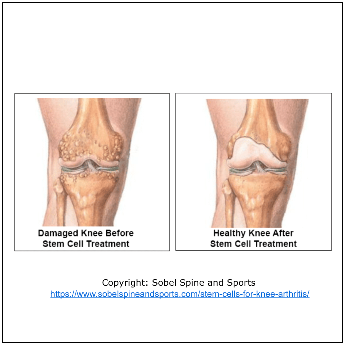 Stem Cell Treatment Knee