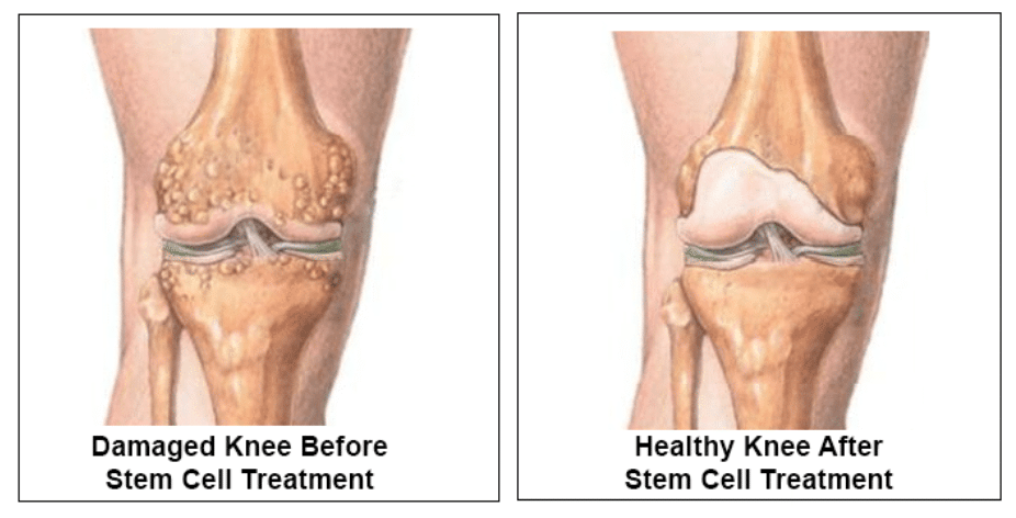 Stem Cell Treatment Knee