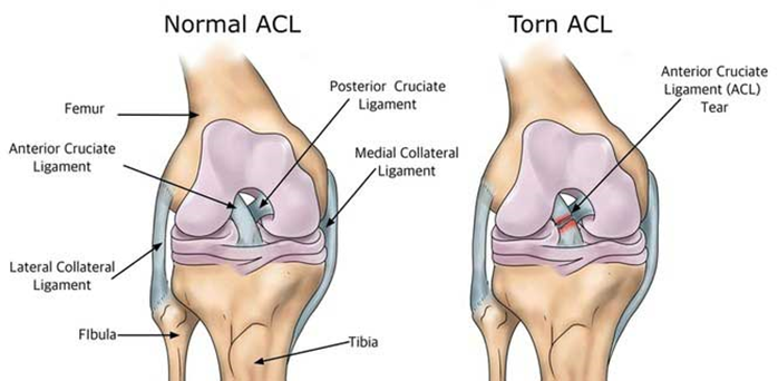 Torn ACL