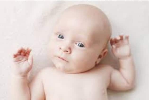 Torticollis: What is it and how can Physical Therapy Help?