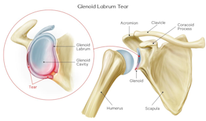 glenoid labrum tear