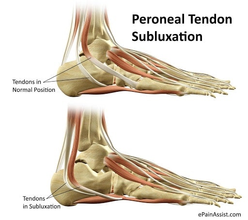 peroneal subluxation comparison