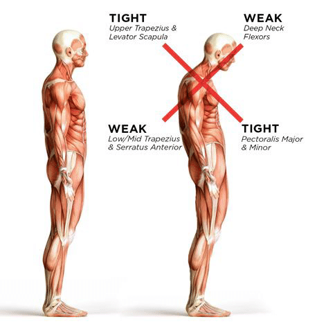 Poor Posture: The Main Culprit Behind Muscle Tension