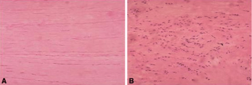 Tendinopathy