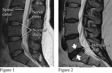 Herniated Disc, Chiropractor, Dr Gary Olson