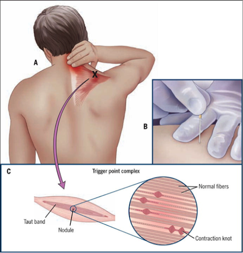 How are the hamstrings (muscles at the back of the upper thigh) involved in  low back pain? - Orleans Core Elements