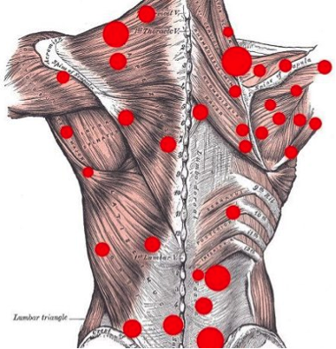 https://a.mpcdn.io/3dpt/2022/11/ifaADGbq-dry-needling-trigger-points.png?fm=png&ixlib=php-3.3.1