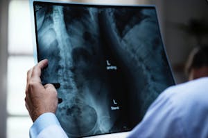 Lumbar spine workers' compensation injury